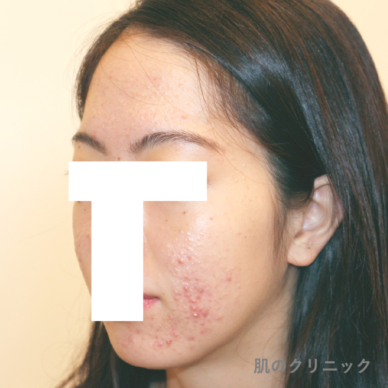 既存のピル治療で改善しなかった20代女性の左側面ニキビ写真。頬から顎にかけての細かい紅色丘疹と小膿疱が多発している治療前状態