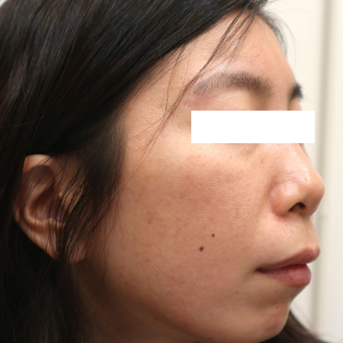 イベルメクチン外用薬とロゼックスゲルによる治療1ヶ月後の酒さ症例(右頬)。治療前と比較し、赤みと丘疹・膿疱が大幅に改善しています。