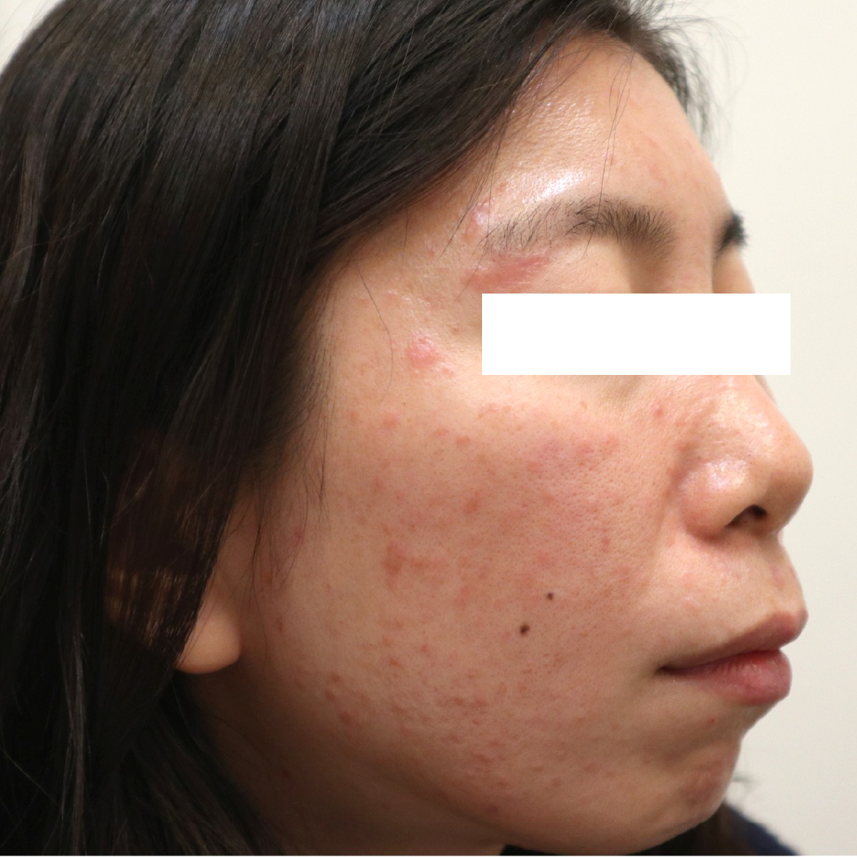 30代女性の丘疹膿疱型酒さ(PPR型)治療前の症例写真(右頬)。顔の赤みと、ニキビに似た赤いブツブツ(丘疹・膿疱)が多数見られます。