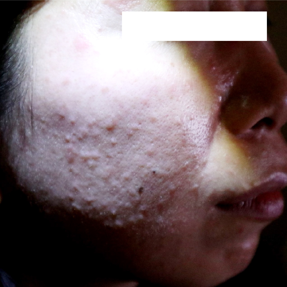 暗室でLEDライトを使用し、皮膚の凹凸を強調した丘疹膿疱型酒さの治療前画像。通常撮影では分かりにくい、多数の細かい丘疹(ブツブツ)が確認できます。