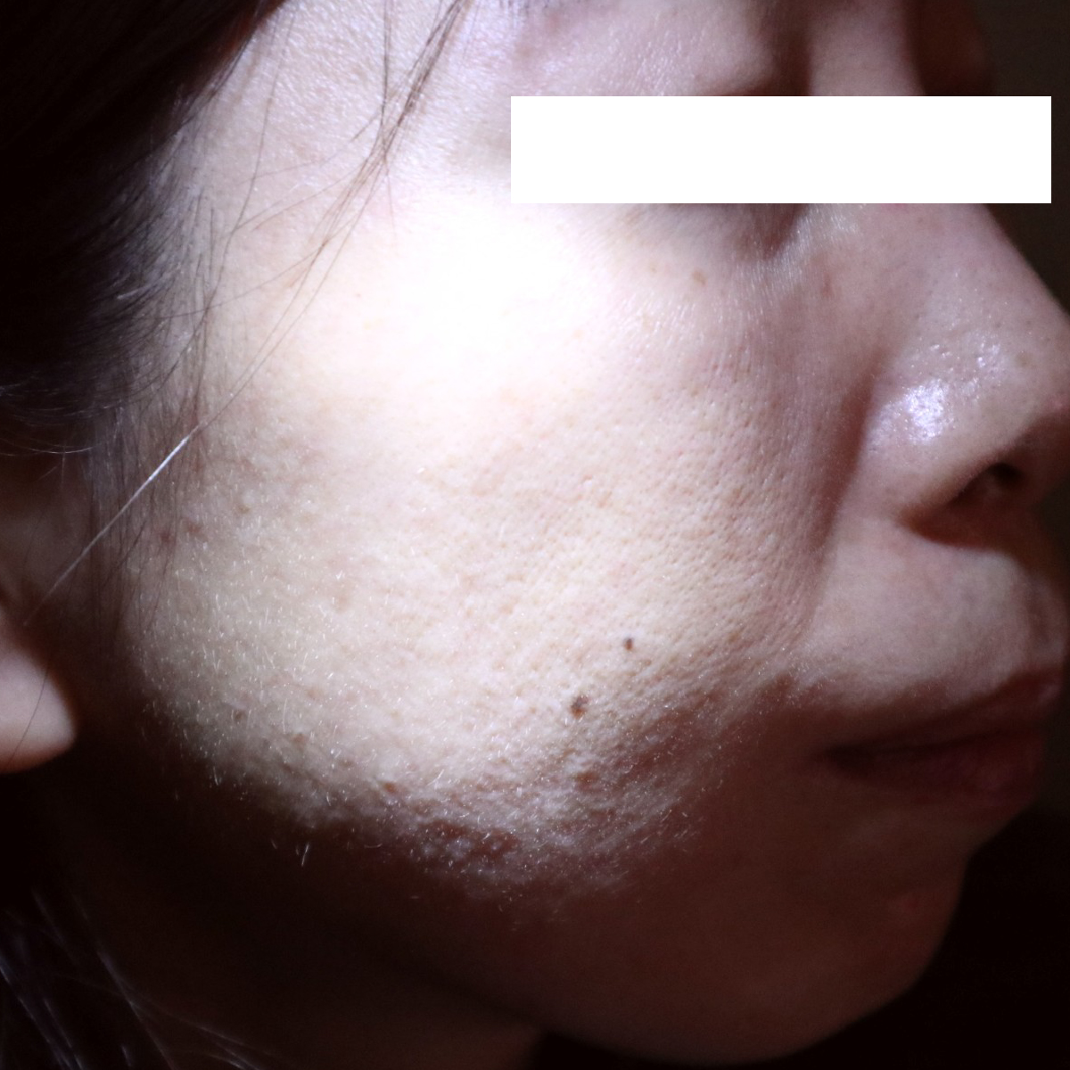 治療1ヶ月後、暗室LED撮影による丘疹膿疱型酒さの経過。治療前と比べて、丘疹の数が劇的に減り、肌表面が滑らかになっていることが分かります。