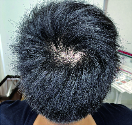 頭皮メディカルアートメイク(SMP)施術前の頭頂部薄毛の状態。地肌が透けて見える