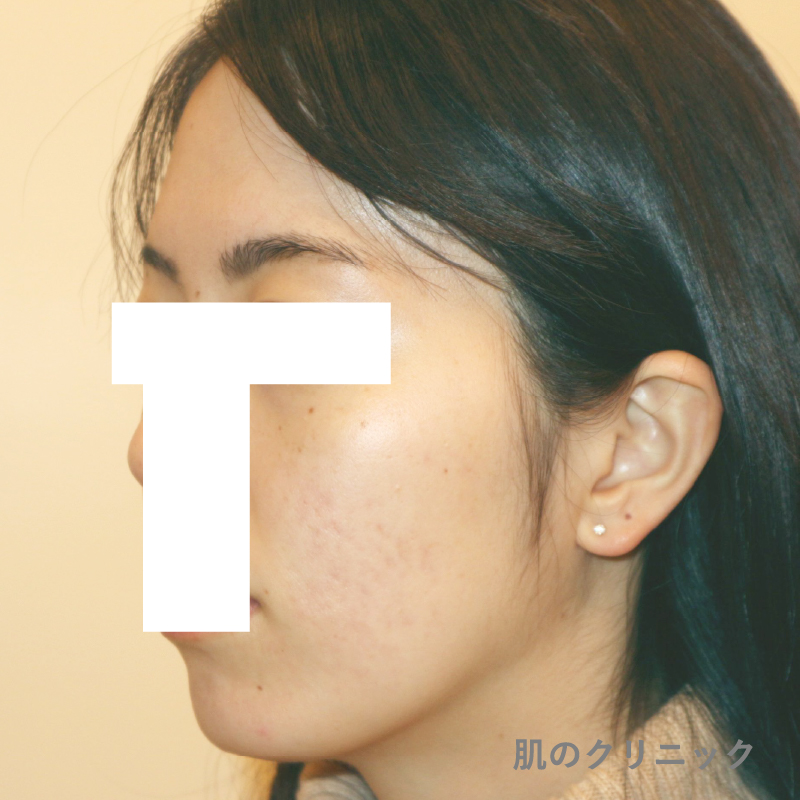 ピル変更とスピロノラクトン追加によるホルモン治療成功例の左側面写真。20代女性の頬と顎の炎症性ニキビが明らかに減少し、肌質も改善した状態
