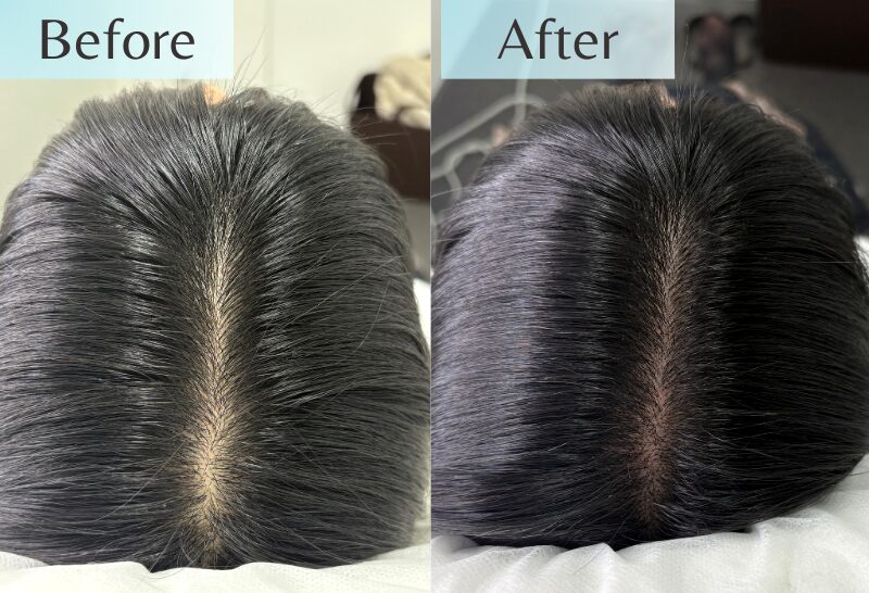 Before and after results of women's scalp micropigmentation (SMP) treatment for visible hair parting. Natural-looking results showing less noticeable parting after just one session of medical scalp artistry treatment.
