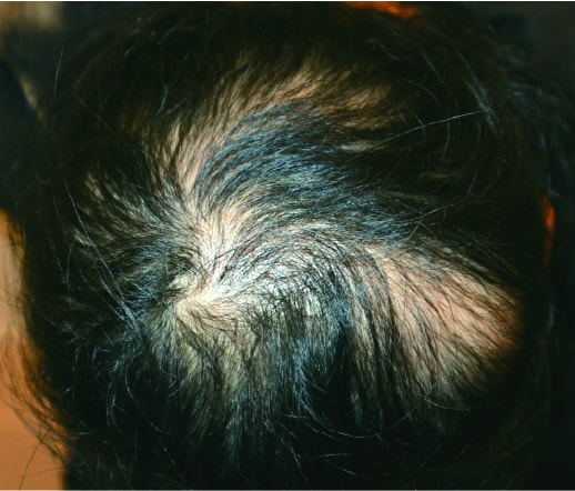 女性型脱毛症の治療前の写真