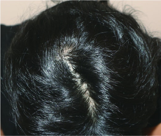女性型脱毛症の治療後の写真
