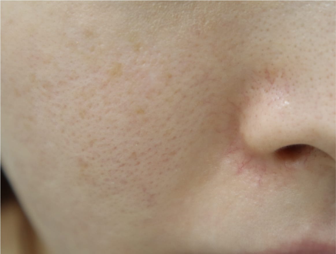 頬の毛穴の症例写真（治療前）