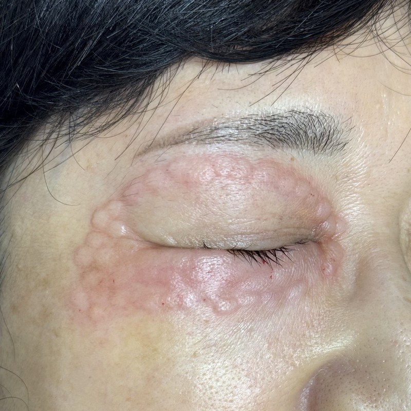 上眼瞼と下眼瞼にスネコスパフォルマ（非架橋ヒアルロン酸）を細かく注入した直後の写真。赤みや細かい盛り上がりが目立つ。