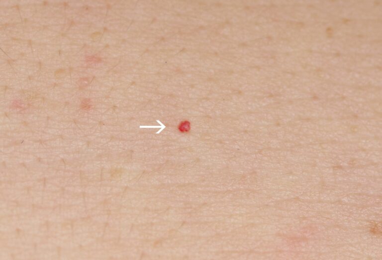 壊れた毛細血管の治療