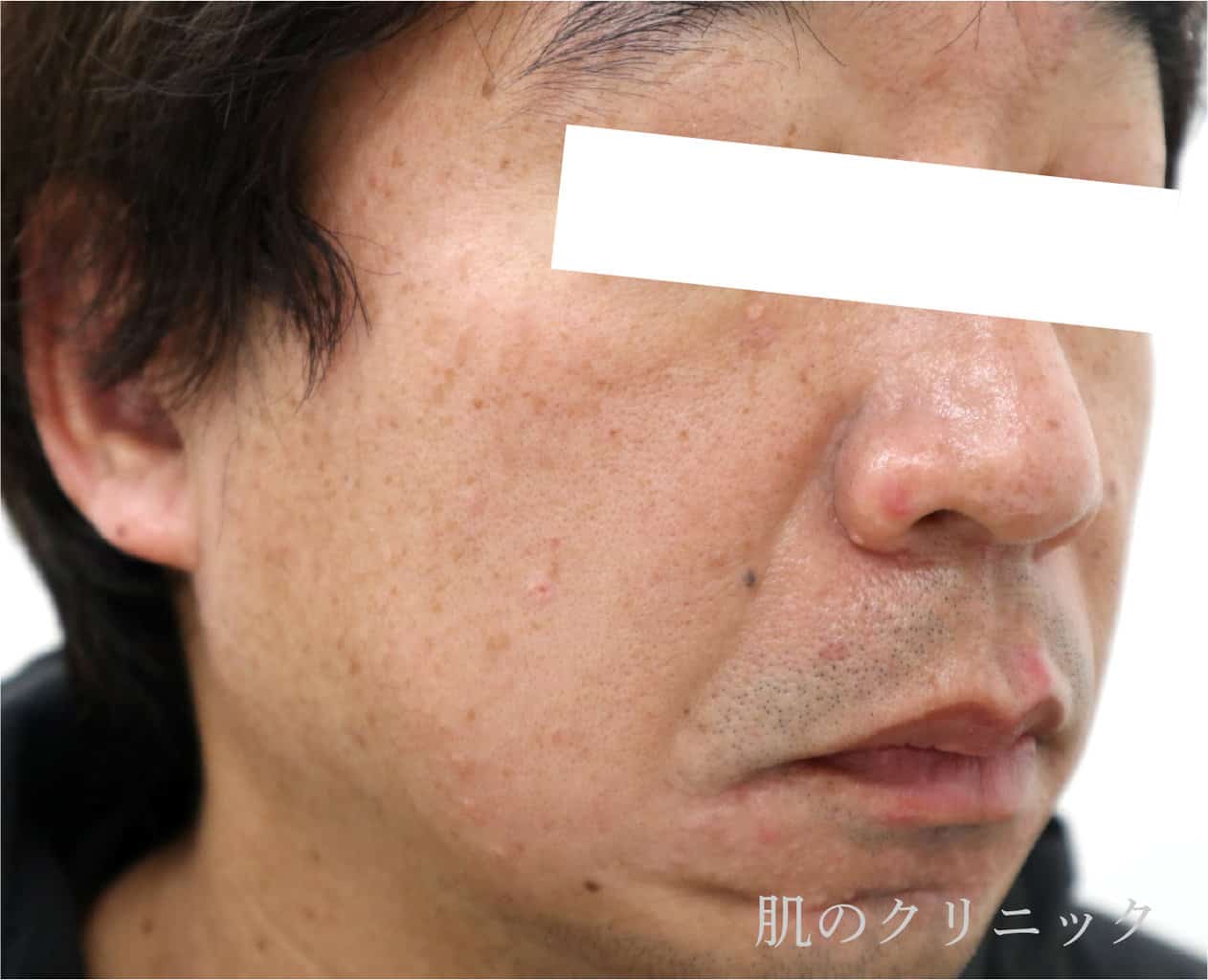 顔の老人性疣贅（脂漏性角化症）のレーザー治療後の写真