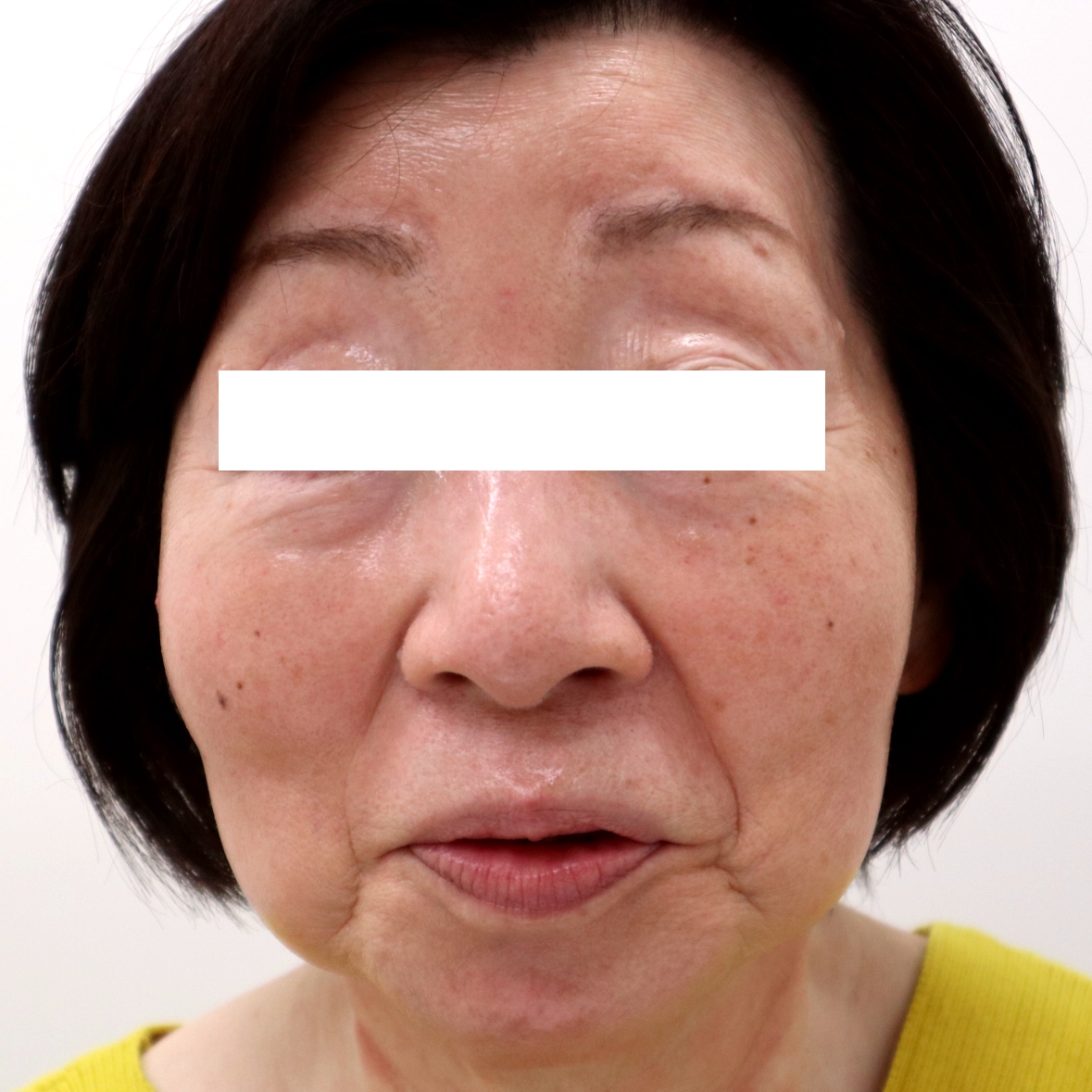 70代女性 酒さの症例写真（顔正面）